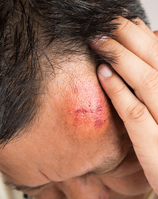 Why Do I Need a Lawyer If I Just Suffered a Concussion?
